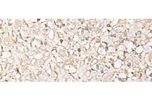 Immunohistochemistry of paraffin-embedded Human ovarian cancer tissue using IGHA1 Polyclonal Antibody at dilution of 1:65(x200) (IGHA1 抗体)