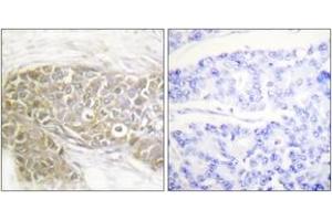 Immunohistochemistry analysis of paraffin-embedded human breast carcinoma tissue, using PEA-15 (Ab-116) Antibody. (PEA15 抗体  (AA 81-130))