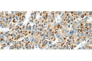 Immunohistochemistry of paraffin-embedded Human liver cancer tissue using THBS2 Polyclonal Antibody at dilution 1:30 (Thrombospondin 2 抗体)