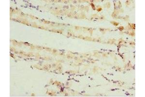 Immunohistochemistry of paraffin-embedded human gastric cancer using ABIN7158947 at dilution of 1:100 (GSTZ1 抗体  (AA 1-216))