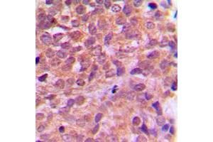 Immunohistochemical analysis of AMPK beta 1 staining in human breast cancer formalin fixed paraffin embedded tissue section. (PRKAB1 抗体  (N-Term))