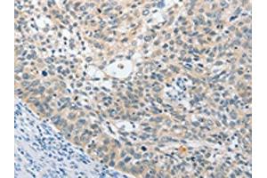 The image on the left is immunohistochemistry of paraffin-embedded Human cervical cancer tissue using ABIN7131538(UCHL5 Antibody) at dilution 1/25, on the right is treated with fusion protein. (UCHL5 抗体)