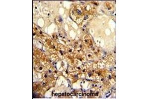 Formalin-fixed and paraffin-embedded human hepatocarcinoma with CYP20A1 Antibody (C-term), which was peroxidase-conjugated to the secondary antibody, followed by DAB staining. (CYP20A1 抗体  (C-Term))