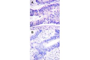 Immunohistochemical staining (Formalin-fixed paraffin-embedded sections) of human colon carcinoma tissue with WASF1 (phospho Y125) polyclonal antibody  under 1:50-1:100 dilution (A) or treated with synthesized peptide (B). (WASF1 抗体  (pTyr125))