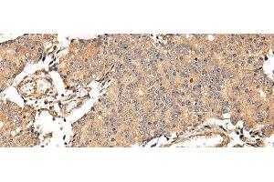 Immunohistochemistry of paraffin-embedded Human prostate cancer using ALDH3A2 Polyclonal Antibody at dilution of 1/20 (ALDH3A2 抗体)
