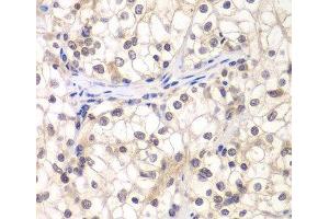 Immunohistochemistry of paraffin-embedded Human kidney cancer using USF1 Polyclonal Antibody at dilution of 1:200 (40x lens). (USF1 抗体)