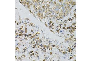 Immunohistochemistry of paraffin-embedded human lung cancer using IRF1 antibody. (IRF1 抗体)