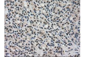 Immunohistochemical staining of paraffin-embedded Adenocarcinoma of colon tissue using anti-TRIB2mouse monoclonal antibody. (TRIB2 抗体)