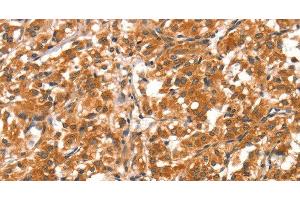 Immunohistochemistry of paraffin-embedded Human thyroid cancer tissue using DAB2IP Polyclonal Antibody at dilution 1:40 (DAB2IP 抗体)
