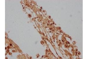IHC image of ABIN7157890 diluted at 1:100 and staining in paraffin-embedded human melanoma cancer performed on a Leica BondTM system. (LAMb4 抗体  (AA 1513-1761))