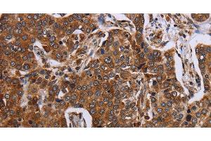Immunohistochemistry of paraffin-embedded Human liver cancer using ACP6 Polyclonal Antibody at dilution of 1:30 (ACP6 抗体)