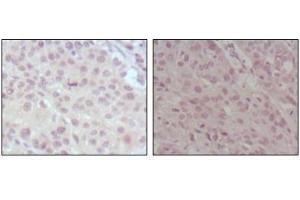 Immunohistochemical analysis of paraffin-embedded human lung cancer (left) and esophagus cancer (right), showing nuclear weak staining with DAB staining using MLL antibody. (MLL/KMT2A 抗体  (AA 3751-3968))