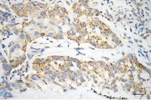 Immunohistochemistry was performed on paraffin-embedded human hepatocarcinoma using ACAT1 antibody (ABIN7797438), 1:200). (ACAT1 抗体)