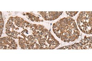 Immunohistochemistry of paraffin-embedded Human esophagus cancer tissue using CAD Polyclonal Antibody at dilution of 1:50(x200) (CAD 抗体)