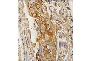 Formalin-fixed and paraffin-embedded human lung carcinoma tissue reacted with ACPP antibody (C-term), which was peroxidase-conjugated to the secondary antibody, followed by DAB staining. (ACPP 抗体  (C-Term))