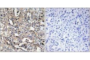 Immunohistochemistry analysis of paraffin-embedded human liver carcinoma, using BAX Antibody. (BAX 抗体  (AA 10-59))