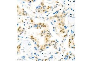 Immunohistochemistry of paraffin embedded human breast cancer using Suv39h2 (ABIN7075771) at dilution of 1:2000 (400x lens) (SUV39H2 抗体)
