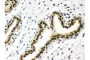 Anti-p95 NBS1 Picoband antibody, IHC(P) IHC(P): Human Mammary Cancer Tissue (Nibrin 抗体  (C-Term))