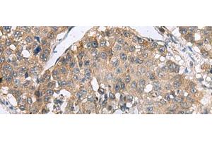 Immunohistochemistry of paraffin-embedded Human liver cancer tissue using RPL18 Polyclonal Antibody at dilution of 1:70(x200) (RPL18 抗体)
