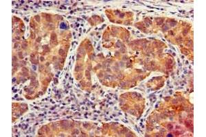 Immunohistochemistry of paraffin-embedded human pancreatic cancer using ABIN7156663 at dilution of 1:100