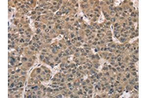 The image on the left is immunohistochemistry of paraffin-embedded Human liver cancer tissue using ABIN7129149(DACH2 Antibody) at dilution 1/40, on the right is treated with fusion protein. (DACH2 抗体)