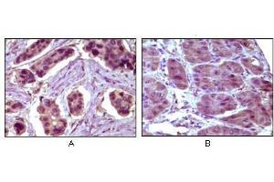 Immunohistochemical analysis of paraffin-embedded human breast carcinoma (A) and liver carcinoma (B), showing cytoplasmic localization using BCL10 antibody with DAB staining. (BCL10 抗体)