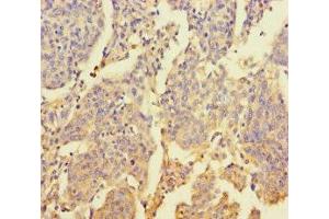 Immunohistochemistry of paraffin-embedded human cervical cancer using ABIN7176469 at dilution of 1:100 (ZNF662 抗体  (AA 182-452))