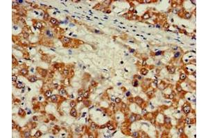 Immunohistochemistry of paraffin-embedded human liver cancer using ABIN7176539 at dilution of 1:100 (Zinc Finger Protein 816A (ZNF816A) (AA 1-200) 抗体)