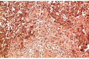 Immunohistochemistry of paraffin-embedded Human lung carcinoma tissue using P38 Monoclonal Antibody at dilution of 1:200. (MAPK14 抗体)