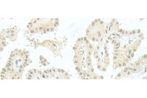 Immunohistochemistry of paraffin-embedded Human thyroid cancer tissue using ESRP2 Polyclonal Antibody at dilution of 1:95(x200) (ESRP2 抗体)