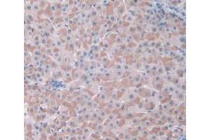 IHC-P analysis of Human Liver Cancer Tissue, with DAB staining. (CDK2 抗体  (AA 94-198))