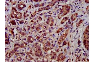 IHC image of ABIN7149946 diluted at 1:500 and staining in paraffin-embedded human pancreatic cancer performed on a Leica BondTM system. (TFB1M 抗体  (AA 59-194))