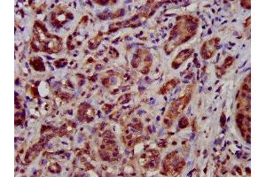 IHC image of ABIN7149946 diluted at 1:500 and staining in paraffin-embedded human pancreatic cancer performed on a Leica BondTM system.