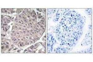 Immunohistochemistry analysis of paraffin-embedded human liver carcinoma tissue using APOL4 antibody. (Apolipoprotein L 4 抗体  (C-Term))