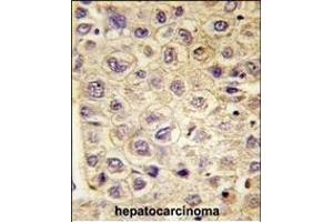 Formalin-fixed and paraffin-embedded human hepatocarcinoma tissue reacted with TYRO3 Antibody (ABIN387820 and ABIN2843907) , which was peroxidase-conjugated to the secondary antibody, followed by DAB staining. (TYRO3 抗体)