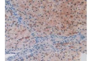 IHC-P analysis of Human Liver Cancer Tissue, with DAB staining. (BACE2 抗体  (AA 230-396))
