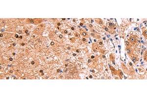 Immunohistochemistry of paraffin-embedded Human liver cancer tissue using TSEN2 Polyclonal Antibody at dilution of 1:80(x200) (TSEN2 抗体)