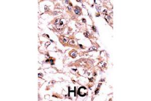 Formalin-fixed and paraffin-embedded human hepatocellular carcinoma tissue reacted with PPP3CC polyclonal antibody  , which was peroxidase-conjugated to the secondary antibody, followed by AEC staining. (PPP3CC 抗体  (C-Term))