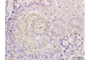 Formalin-fixed and paraffin embedded human esophageal carcinoma labeled with Anti-ROCK1 Polyclonal Antibody, Unconjugated (ABIN738636) at 1:200 followed by conjugation to the secondary antibody and DAB staining. (ROCK1 抗体  (AA 1001-1200))