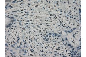 Immunohistochemical staining of paraffin-embedded Carcinoma of pancreas tissue using anti-PPP1R7mouse monoclonal antibody. (PPP1R7 抗体)