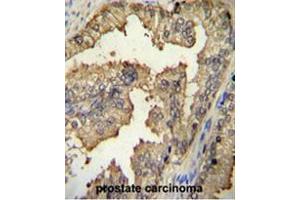 PRMT4 Antibody (Center) immunohistochemistry analysis in formalin fixed and paraffin embedded human prostate carcinoma followed by peroxidase conjugation of the secondary antibody and DAB staining. (CARM1 抗体  (Middle Region))