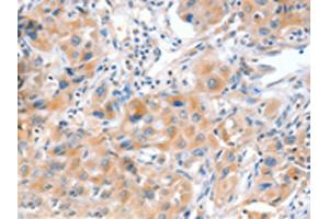 The image on the left is immunohistochemistry of paraffin-embedded Human lung cancer tissue using ABIN7128172(ACOX2 Antibody) at dilution 1/20, on the right is treated with fusion protein. (Acox2 抗体)