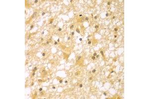 Immunohistochemistry of paraffin-embedded human brain cancer using PAK6 antibody. (PAK6 抗体  (AA 1-270))