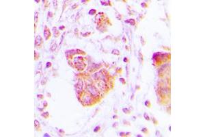 Immunohistochemical analysis of MOV10L1 staining in human lung cancer formalin fixed paraffin embedded tissue section. (MOV10L1 抗体  (Center))