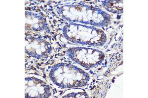 Immunohistochemistry of paraffin-embedded Human colon using SND1 Rabbit pAb (ABIN6129741, ABIN6148197, ABIN6148199 and ABIN6221577) at dilution of 1:100 (40x lens). (SND1 抗体  (AA 26-285))
