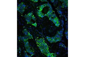IF analysis of HSP90AB1 using anti-HSP90AB1 antibody (ABIN3042462) HSP90AB1 was detected in paraffin-embedded section of human lung cancer tissues.