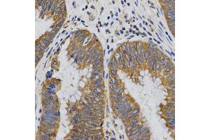 Immunohistochemistry of paraffin-embedded human rectal cancer tissue using PIBF1 antibody at dilution of 1:200 (x400 lens). (PIBF1 抗体)