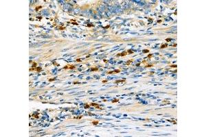 Immunohistochemistry of paraffin embedded human gastric cancer using CD307 (ABIN7073931) at dilution of 1:600 (300x lens) (FCRL5 抗体)