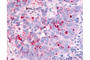 Anti-CDC7 antibody IHC of human Lung, Non-Small Cell Carcinoma. (CDC7 抗体  (Kinase Domain))