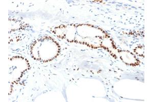 Formalin-fixed, paraffin-embedded human Breast Carcinoma stained with Estrogen Receptor alpha Mouse Monoclonal Antibody (ESR1/1904). (Estrogen Receptor alpha 抗体)